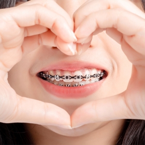 What Are the Different Types of Braces?