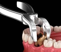 Signs You Might Need a Tooth Extraction