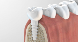 Understanding the Process of Dental Implants in Wilmslow