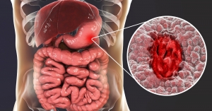 Robotic Gastro Surgeon in India