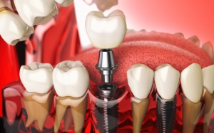 The Dental Crown Procedure: A Detailed and Step-by-Step Journey for your Oral Health