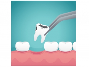 4 Things to Know Before Getting a Tooth Extraction