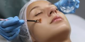 The Science of Chemical Peels: How Acids Reveal Younger-Looking Skin