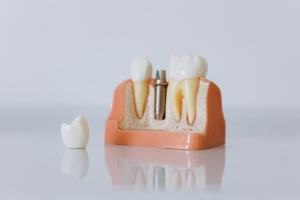 Epping dental implant clinic - Serenity Smiles Dental