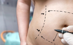 Can Tummy Tucks Reduce Back Pain From Weak Abdominal Muscles?