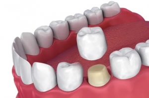 Best Dental Clinic in Lahore Dental Crowns Treatment in Lahore by Dr. Imran’s Multispeciality Dental Care