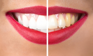 The Long-Term Benefits of Smile Makeovers at North Texas Family & Cosmetic Dentistry
