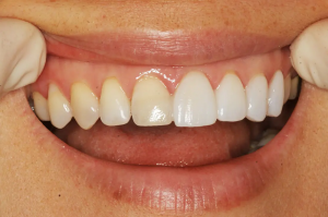 Why Non-Prep Veneers Are Gaining Popularity?