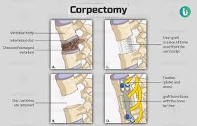 Chirurgie de corporectomie en Inde : Une option de soin avancée à coûts réduits