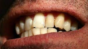 Should I Get Braces or Invisalign for Crooked Teeth?