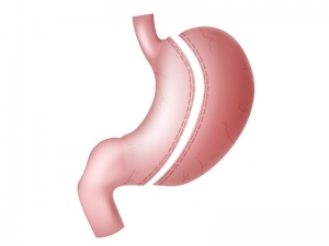 What are common myths about gastric sleeve surgery?