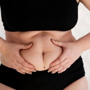 Who Is an Ideal Candidate for Liposuction in Riyadh?