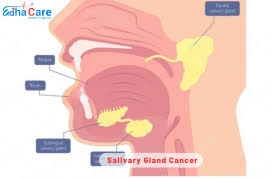Cancer des glandes salivaires en Inde : Traitement avancé, soins humains et coût abordable