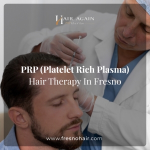 The Rise of PRP Treatment for Hair Loss in Fresno