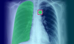 How Medical Image Annotation Is Advancing Early Diagnosis