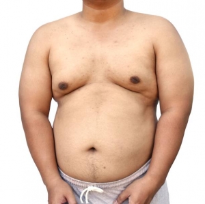 What is the Success Rate of Gynecomastia Surgery in Riyadh?