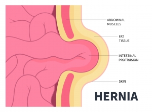 What Can Cause a Hernia? Diet, Age, and Genetics Explained
