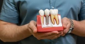 How Long Do Same-Day Dental Implants Last?
