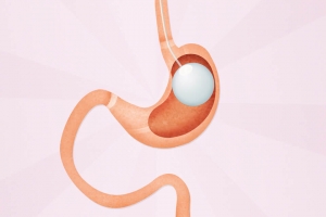 Cost Breakdown of Gastric Balloon in Dubai Clinics