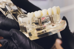 Rebuilding Your Smile: Why Dental Implants in Dubai are the Gold Standard for Tooth Replacement
