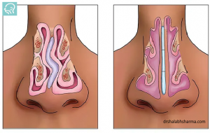Why Dr. Shalabh Sharma is Considered the Best Septoplasty Surgeon in Delhi
