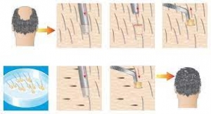DHI Hair Transplant Turkey: Your Ultimate Guide to a Fuller Head of Hair