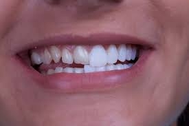 Dental Veneers: Cost Breakdown & What to Expect