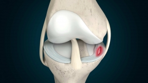Ligament Injury Treatment Options in Kolkata for All Ages