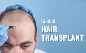 How Hair Transplants Help Cover Frontal Balding Issues?