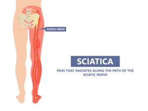 Sciatica With Groin Pain | safe4cure