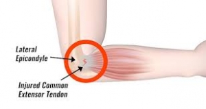 Active Tennis Elbow Pain Treatment in Ahmedabad – Impulse Pain Clinic