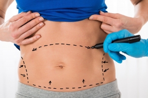 Liposuction Dubai Smooths Out and Snatches You Fast