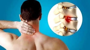 Traitement de la spondylose cervicale en Inde : Soins spécialisés à prix abordables
