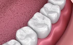 Do Composite Fillings Hurt?