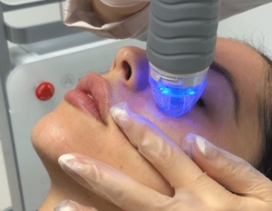 What Is Fractional RF Microneedling? A Beginner-Friendly Guide