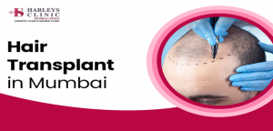 Why Is BIO FUE Hair Transplant the Choice of Many for Hair Loss Management?