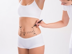 Pre-Tummy Tuck Preparation Tips in Islamabad