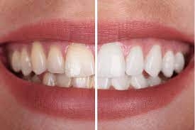 Does Zoom Teeth Whitening Hurt?