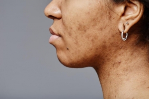 How to Treat Hyperpigmentation at Clinics in Edinburgh