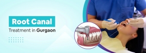 Painless Root Canal Treatment in Gurgaon