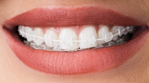 Ceramic Braces Hybrid: Combining Clear Aligners with Discreet Brackets