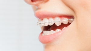 Adult Teeth Straightening: Why It’s Never Too Late for Orthodontic Treatment