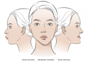 Mandibular Repositioning Technology1