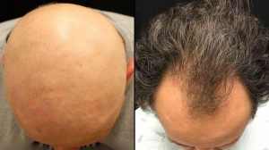 Alopecia Areata Treatment Market: Size, Trends, and Strategies 2025-2032