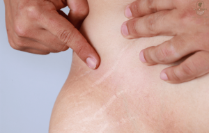 Stretch Mark Reduction Treatment