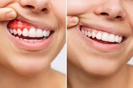 How Much Does Gum Contouring Cost?
