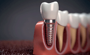Latest Trends in Single Tooth Implant in Dubai