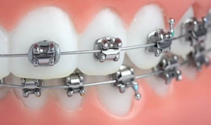 Eating with Braces: The Ultimate Do’s and Don’ts