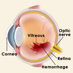 Understanding Vitreous Hemorrhage: Causes, Symptoms & Ayurvedic Care at Vedicmed