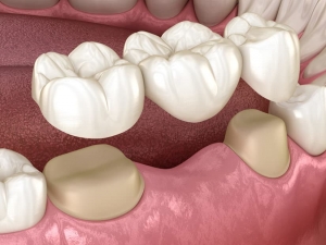 Dental Crown